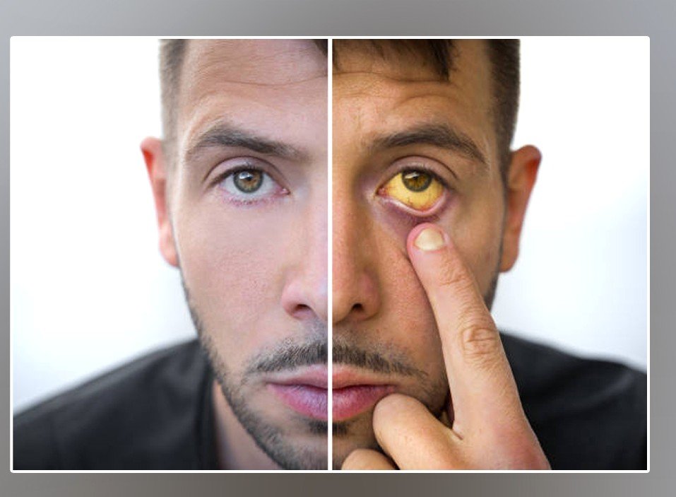 जन्डिस किन हुन्छ, जान्नुहोस् लक्षण र बच्ने उपाय